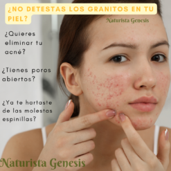 Loción Anti Acne | 225ml | De Azufre | Espinillas | Barros